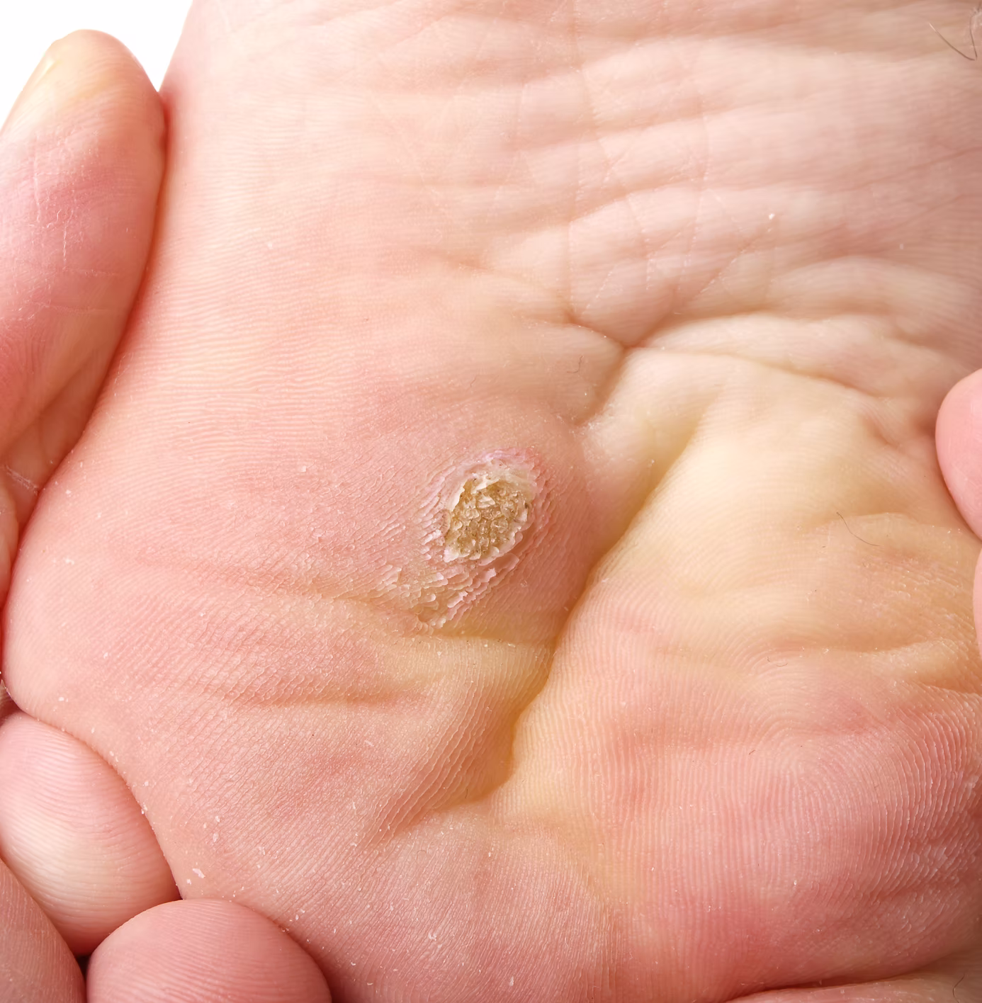 Close-up of a plantar verruca assessed at The Verruca Clinic NI Belfast